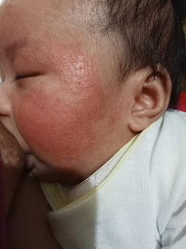Help po mga mii
Ano pwedi igamot dto sa rashes ni baby. 2 months na ng baby ku ngayon