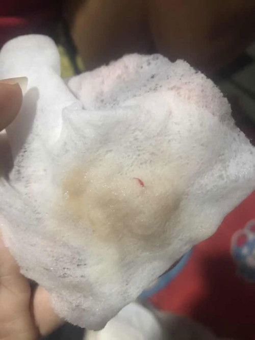 เกี่ยวกับการฝังเข็มมั้ยคะ