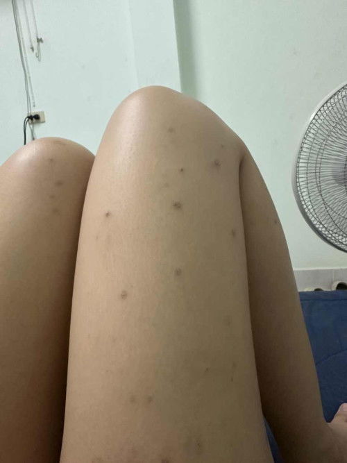 ตุ่มคันตามตัวเต็มขาและก้นและหลัง พอเกาจะเป็นแผลทิ้งรอยเป็นจุดดำๆ ตอนนี้เครียดมากค่ะ ไม่มีวี่แววจะหายคันขึ้นเรื่อยๆ