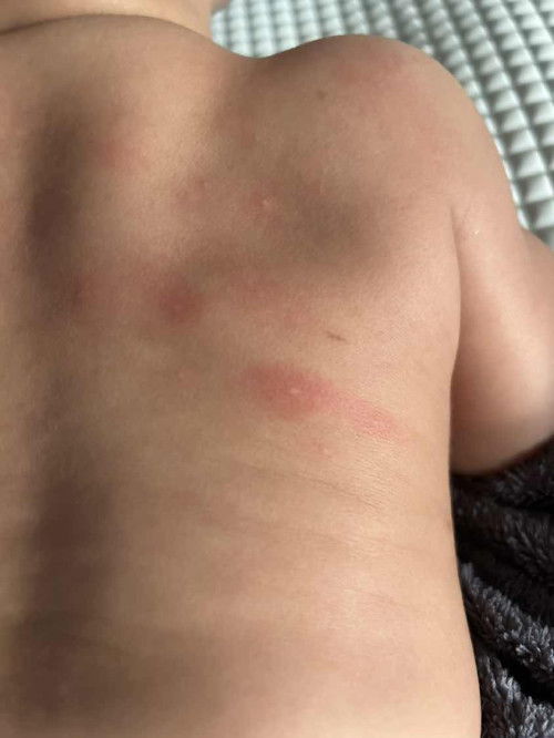 Bercak merah dipunggung bayi