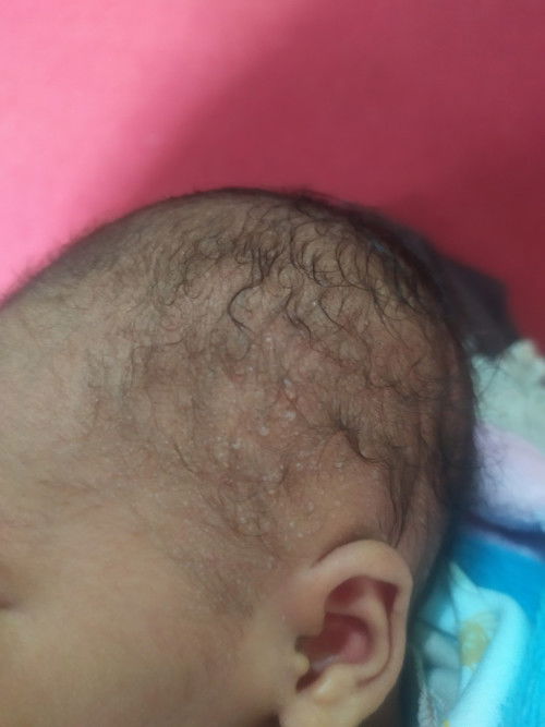 Bun bayi 8 hari beruntusan kaya berair gitu, harus pakai apa ya, kasian penuh bgt kepala nya..