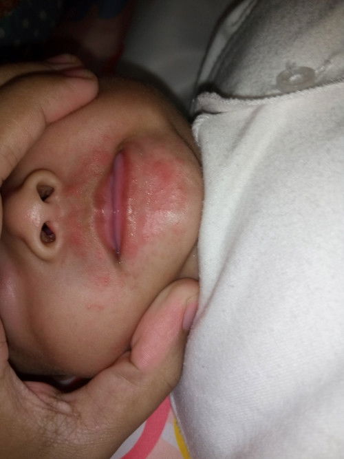 Bercak merah di dagu bayi