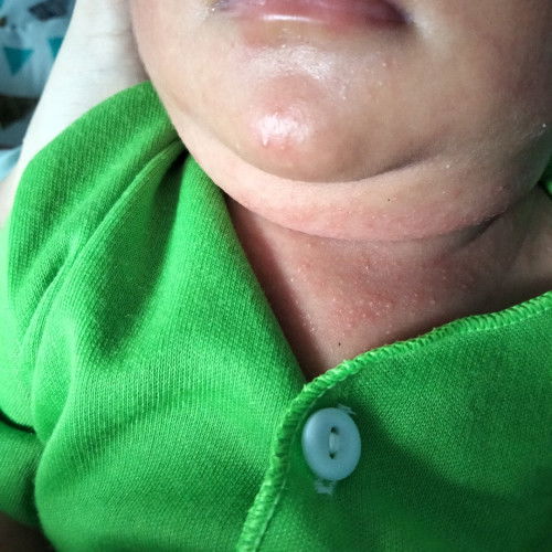 beruntusan di sekitar leher