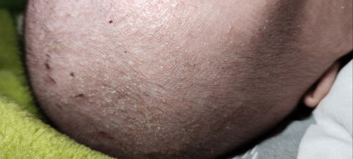 Kulit kepala selalu nglupas kaya ketombe