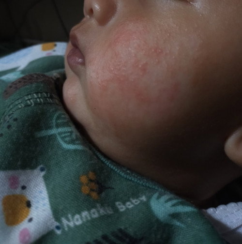Muka bayi bintik bintik merah