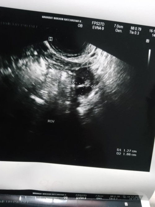 ใช่ถุงตั้งครรภ์ไหมคะ