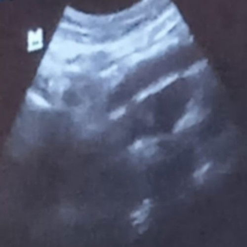 Masih belum ada kantung janinx