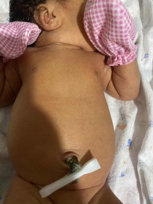 สอบถามแม่ๆค่ะ แบบนี้พุงน้องดูป่องๆมั้ยคะ น้องได้17วันค่ะ ทามหาหิงค์แล้วจับเรอน้องเรอยากมากค่ะ