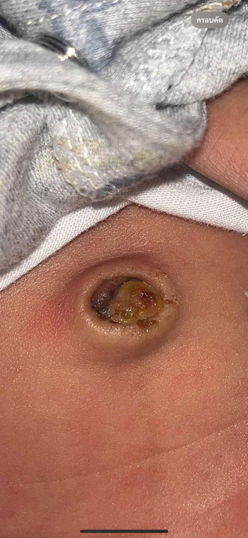 สะดือหลุดแล้วแต่มีแบบนี้ข้างในปกติมั้ยคะ?