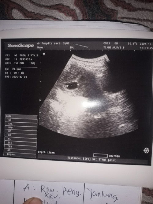 Ini hasil usg sya bunda, 8w kata dr.spog janin belm ada. Apakah pernh ada yg mengalami? Smpt flek 2h