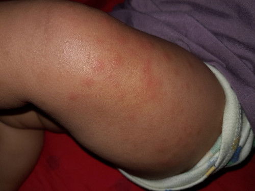 Ruam kemerahan di badan