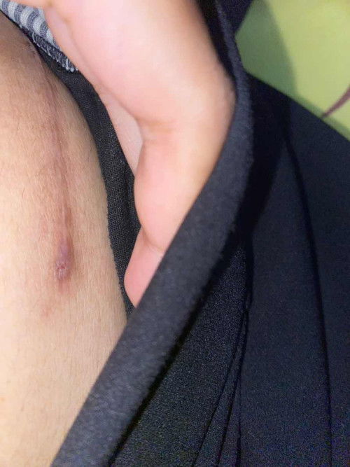 ผ่าคลอดได้7เดือนแล้วเหมือนแผลจะเป็นหนองใช่มั้ยแม่ๆ