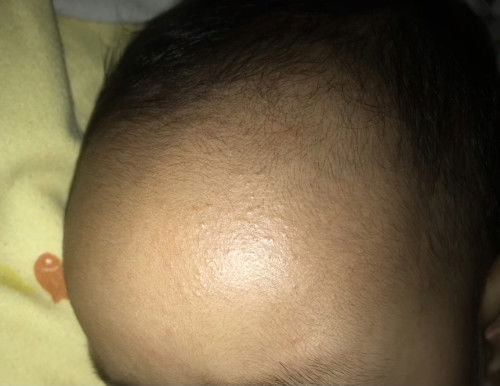 BRUNTUSAN PADA WAJAH