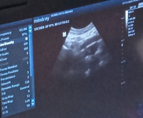 Yg bisa baca hasil USG dong bunda mohon bantuannya