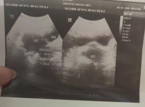USG2 dimnsi 6week normal ktnya br ad kntong janin tp blm ad janin