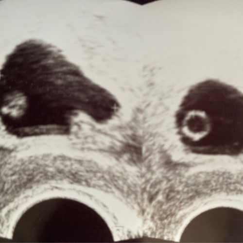 Hamil 7w janin belum terlihat