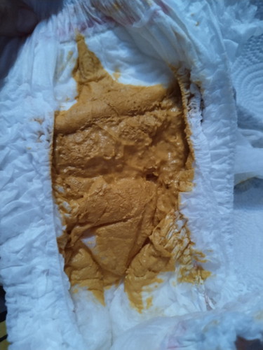 ขออนุญาตนะค่ะ ลูกถ่ายแบบนี้ปกติไหมค่ะ