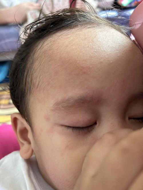 Rashes sa buong mukha ni baby