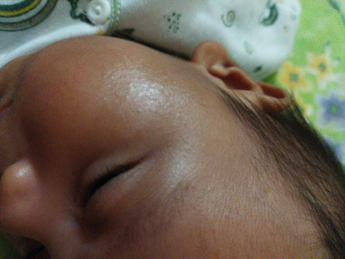 Bunda bunda mau tanya dong, kalau pipi bayi kulit nya Kya bgini itu kenapa ya..