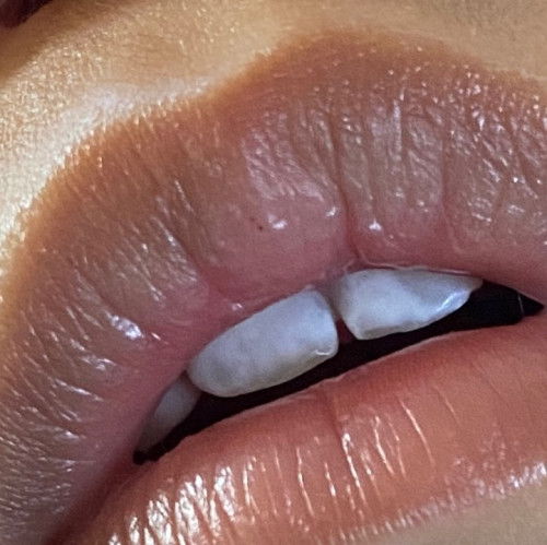 ฟันตกกระ มีวิธีรักษาหรือวิธีทำให้หายไหมคะ