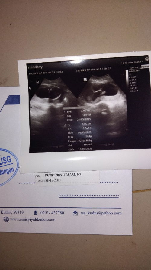 Hamil 18w posisi sungsang
