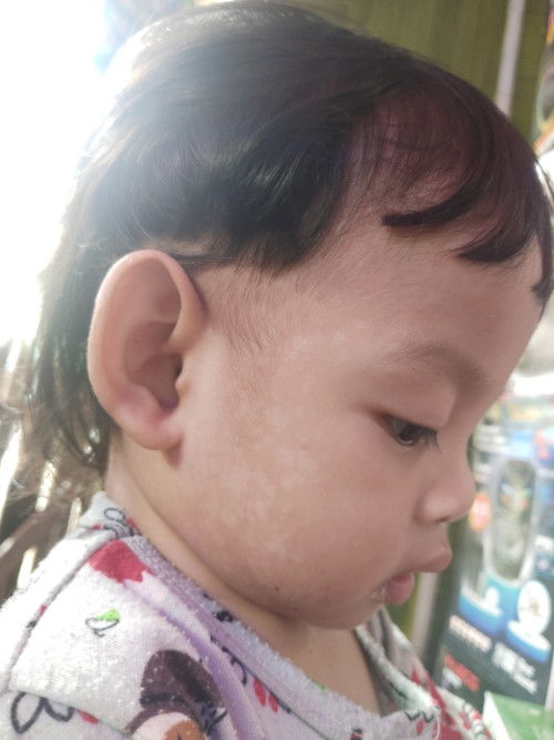 Bercak putih2 d wajah anak umur 22bulan.