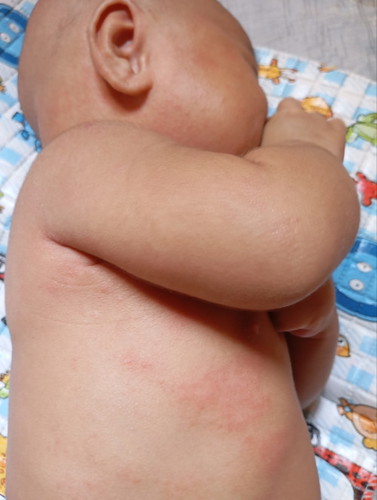 Minta saran bun anak saya sudah usia 2 bulan dari usia 2 minggu muncul gatal" Kira" Kenapa ya