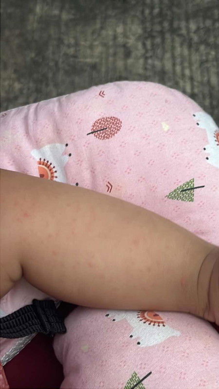 Ano po ito? possible po ba na bulutong na po?