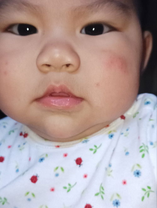 น้อง 7 เดือน 10 วัน เหมือนมีผื่นหรือผิวแตก อยากสอบถาม บ้านไหนเคยเป็นบ้างค่ะ