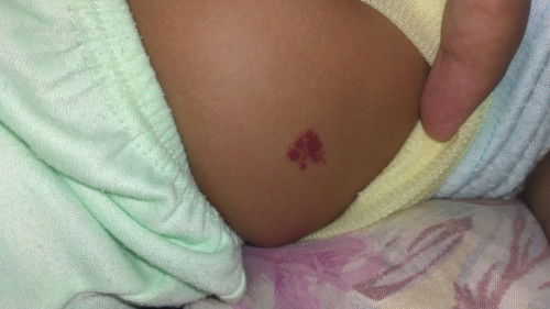 Tanda lahir merah diperut