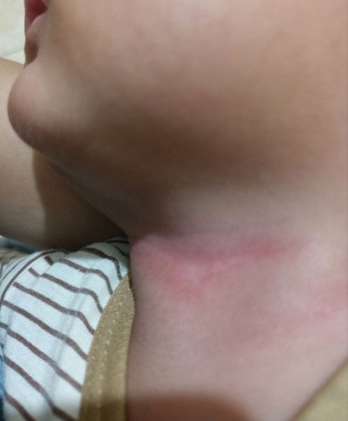 Kemerahan pada leher bayi