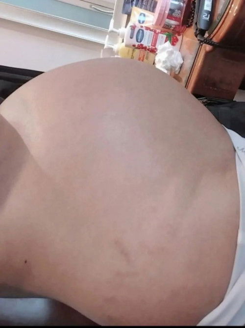 รอยแตกลายหลังคลอดจะหายไหม?