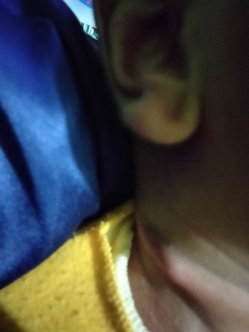 Kolo boleh tahu ini kenapa ya udah 2 hari ga hilang" kaya gigitan nyamukk