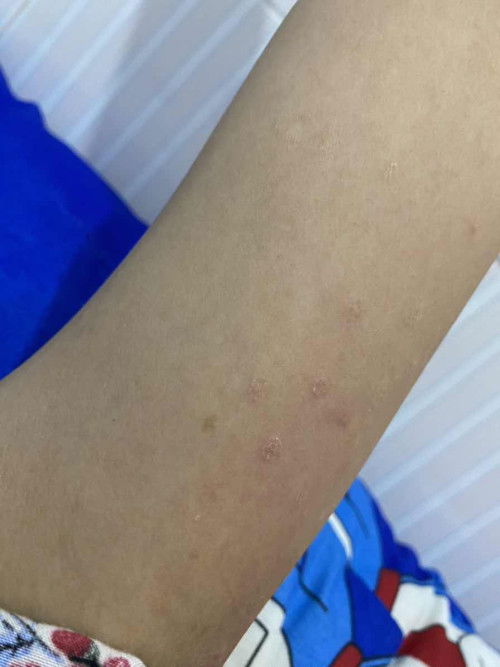 Gatal Sebelum lahiran sampai menyusui