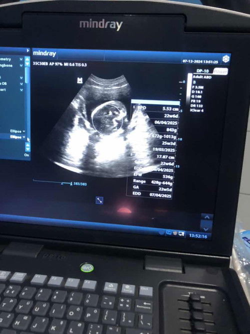 Cara liat bb janin dan tb nya dmna ya bund