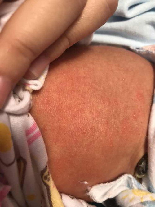 ผดผื่นตุ่มแดงๆใสๆ