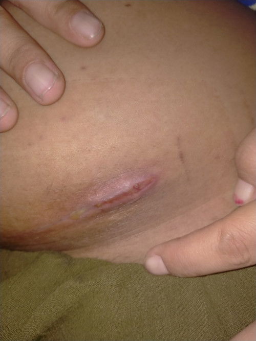 Lahiran SC samping luka SC ber,air dan berkoreng kira2 aman GG ya mohon maaf kalo jorok / sdkt nyen