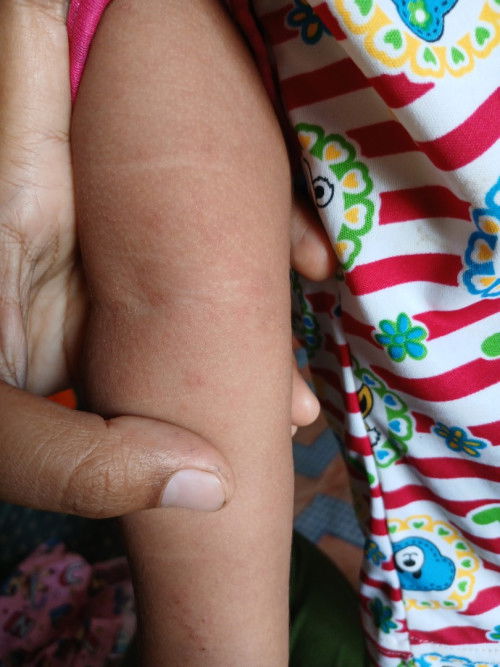 Kira2 alergi apa ya?