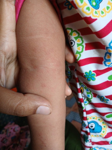 Kira2 alergi apa ya?