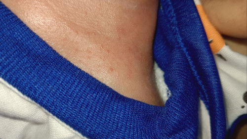 Cara mengatasi ruam bayi