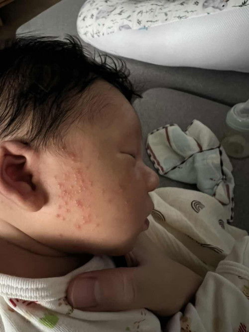 น้องมีผดผื่นร้อน