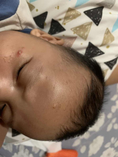 Bintik merah seperti jerawat dan bintik seperti komedo mendem