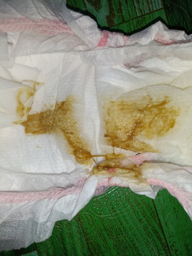 Poop ni baby may kasamang something brown na malagkit?