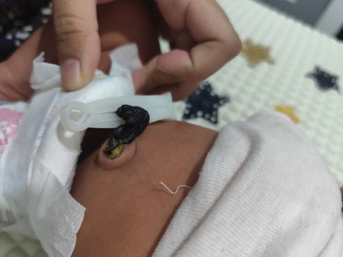 Pangkal Tali pusar basah