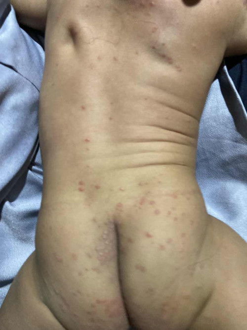 Gatal gini dikasih apa ya?