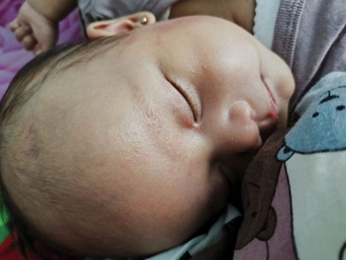 Beruntusan di wajah dan leher