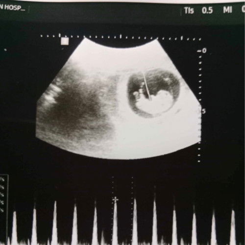 ซาวตอน 9-10 วีคค่ะ รูปร่างน้องแปลกๆไหมค่ะต้นคอเหมือนจะใหญ่ๆ