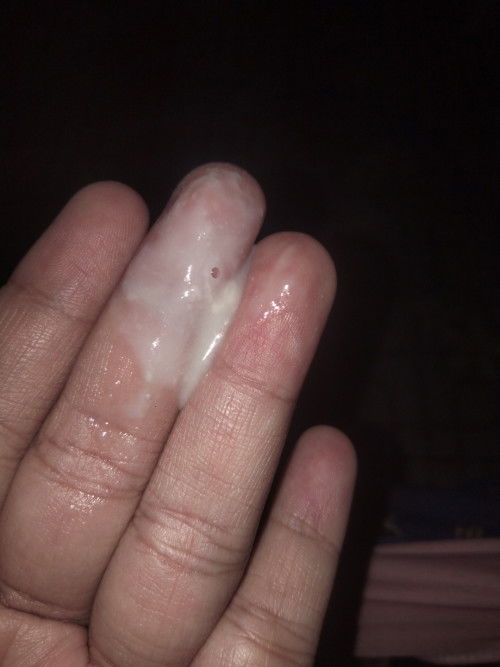 แบบนี้คือมูกหรือแค่ตกขาวคะ