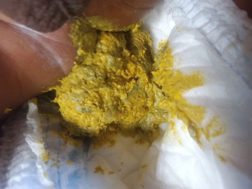 อุจาระเเบบนี้ปกติมั้ยค่ะ