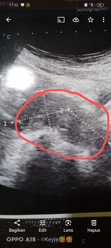 USG udah 3x Alhamdulillah janin ada